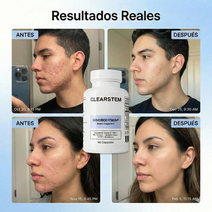 CLEARSTEM® – Fórmula Avanzada para Acné Hormonal y Piel Clara