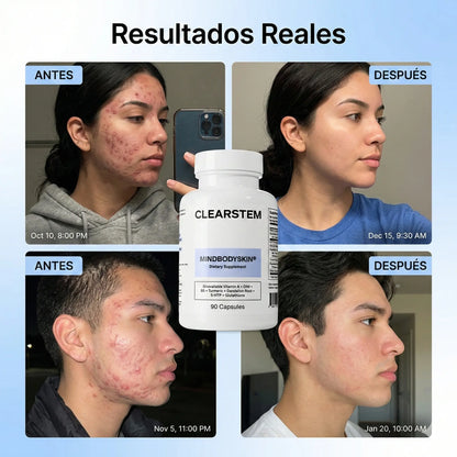 CLEARSTEM® – Fórmula Avanzada para Acné Hormonal y Piel Clara
